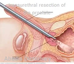 transurethral resection of the prostate